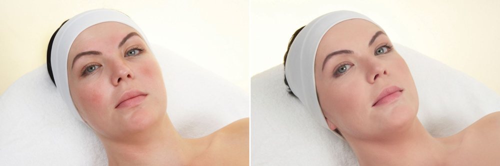 Antes y después — Unstress