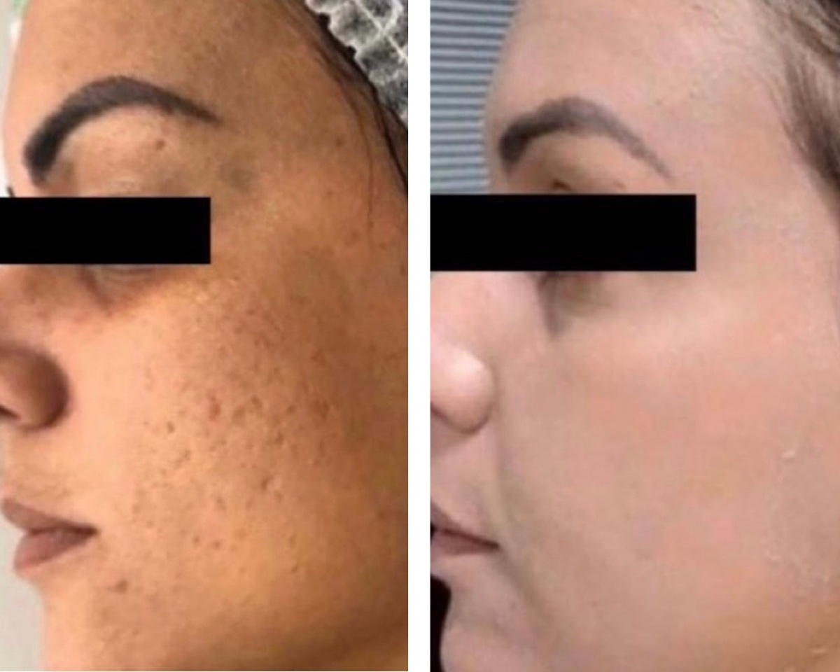 Antes y después — Rose de Mer