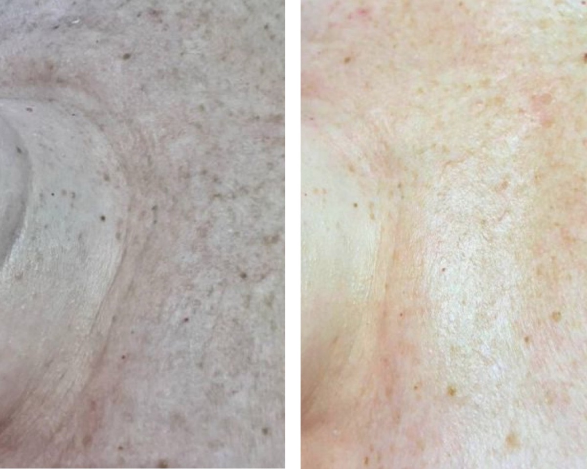 Antes y después — Nude
